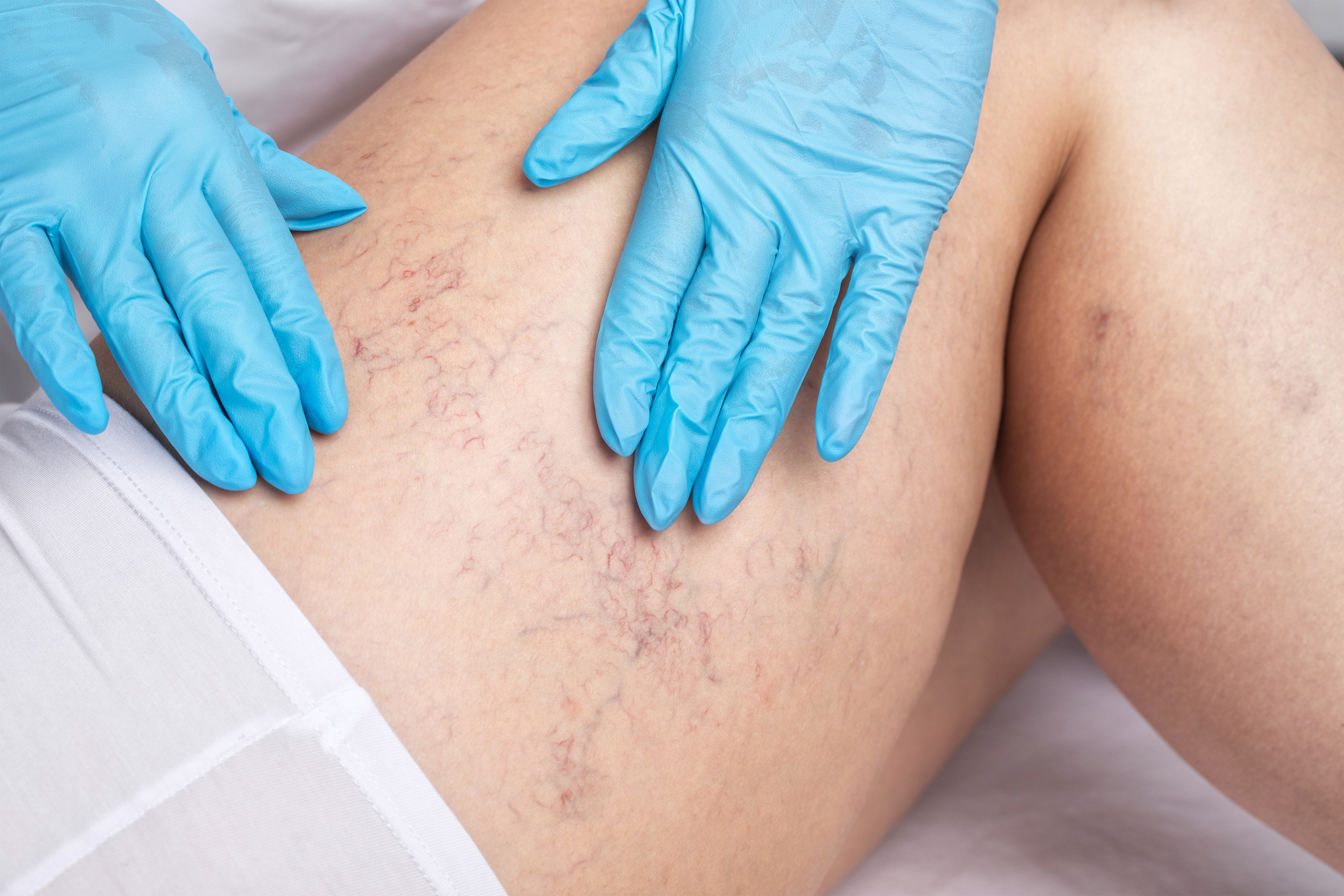 Spider Veins hero image