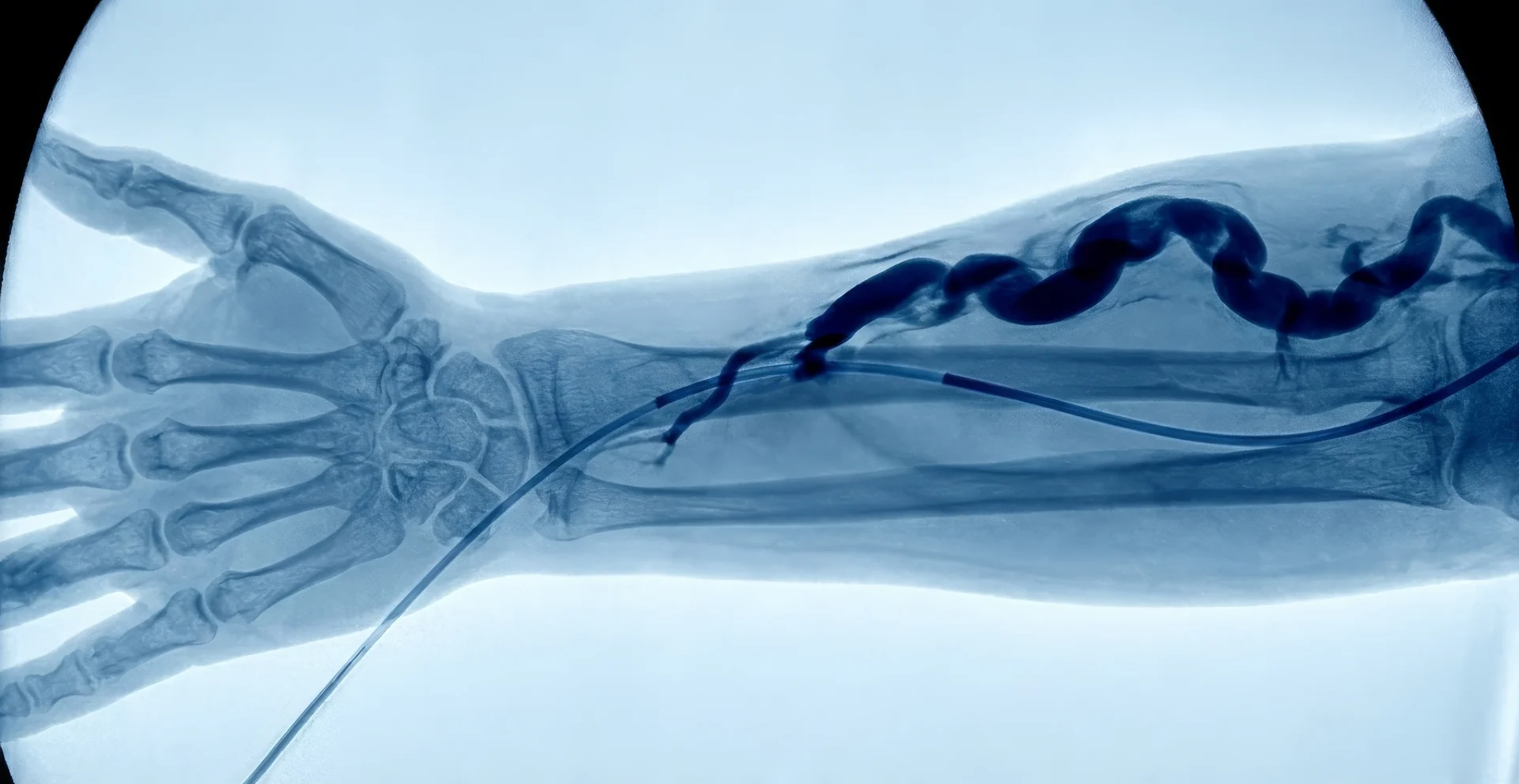 Fistulography X-ray of a forearm dialysis access, showing the catheter and contrast-filled fistula under fluoroscopic guidance