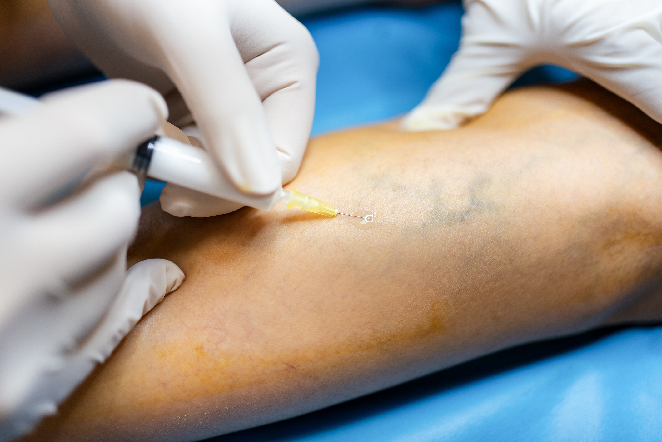 Sclerotherapy hero image